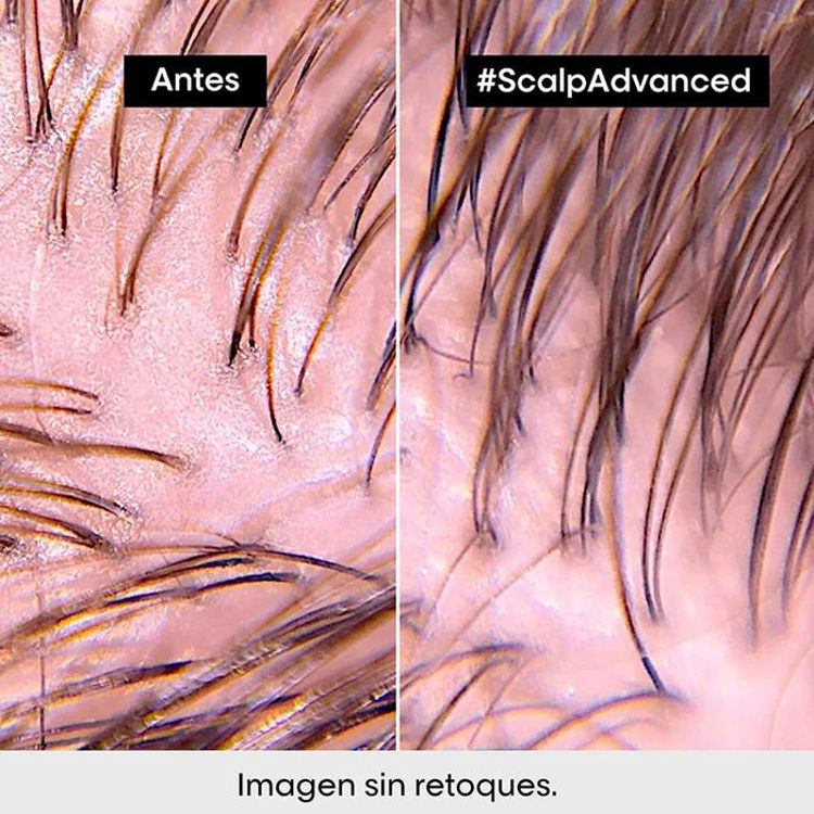Imagen de L'Oreal Professionnel Serie Expert Scalp Advanced Anti-Disconfort Shampoo 300 ml